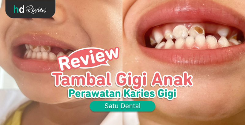 Review Tambal Gigi Anak di Satu Dental untuk Atasi Karies Gigi, gigi berlubang, lubang pada gigi, lubang coklat di gigi