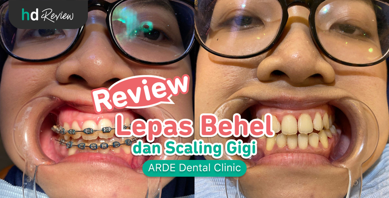 Review Lepas Behel di ARDE Dental Clinic, Sambut Gigi Rapi dan Bersih dengan Harga Terjangkau, pelepasan behel, kawat gigi, behel gigi, retainer gigi