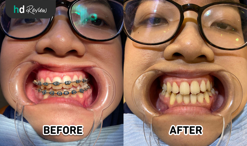 Review Lepas Behel di ARDE Dental Clinic, Sambut Gigi Rapi dan Bersih dengan Harga Terjangkau, pelepasan behel, kawat gigi, behel gigi, retainer gigi