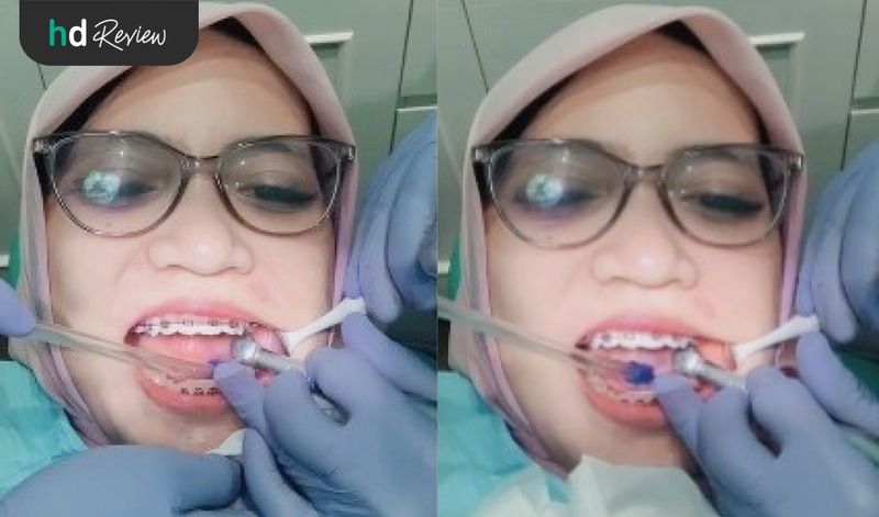 Review Cabut Gigi di A+ Dental Care, Optimalkan Gigi Rapi saat Pakai Behel