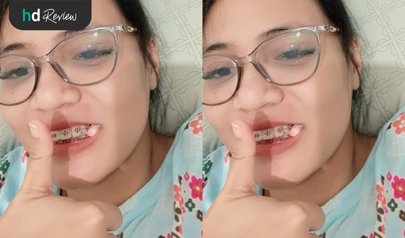 Review Cabut Gigi di A+ Dental Care, Optimalkan Gigi Rapi saat Pakai Behel