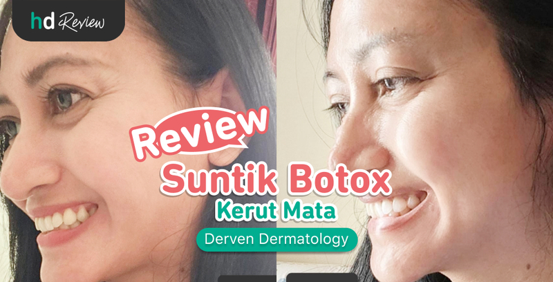 Review Botox Kerut Mata di Derven Dermatology, Wajah Awet Muda Bikin Makin Pede!, suntik botox, botox wajah