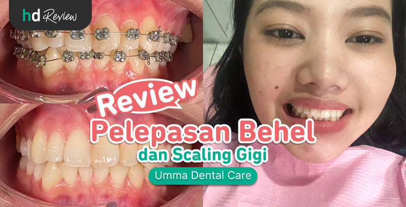 Review Lepas Behel di Umma Dental Care, Gigi Rapi dan Bersih!, pelepasan behel, kawat gigi