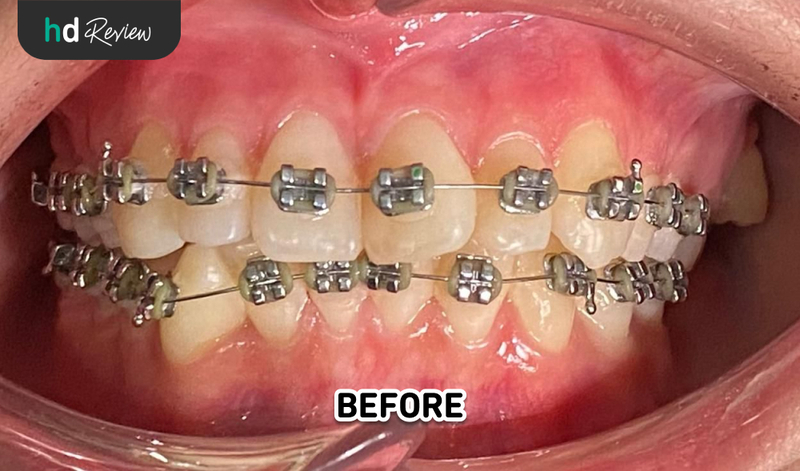 Hasil sebelum pelepasan behel di Umma Dental Care