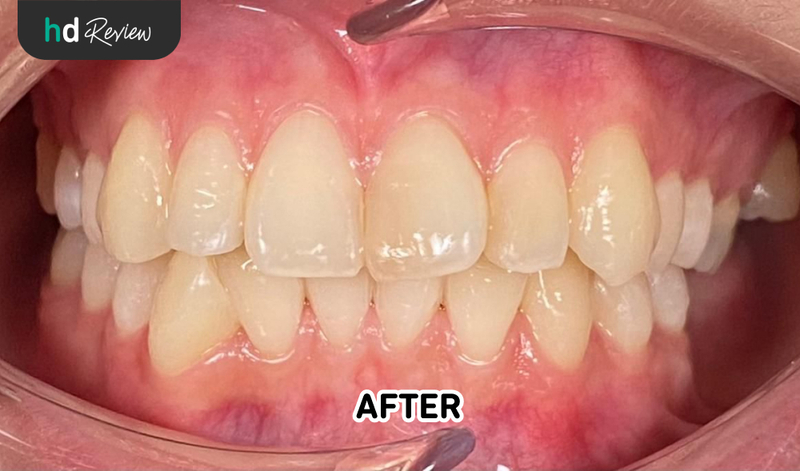 Hasil setelah pelepasan behel di Umma Dental Care