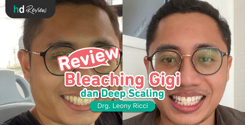 Review Bleaching Gigi di Drg. Leony Ricci, Gigi Putih Naik 8 Tingkat!, memutihkan gigi