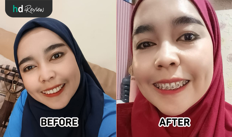 Foto before-after pakai behel metal comfort mini di Tooth Signature