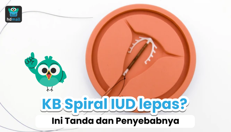 KB spiral IUD KB spiral IUD