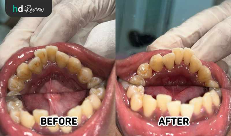 Hasil scaling gigi di JB Dental Clinic