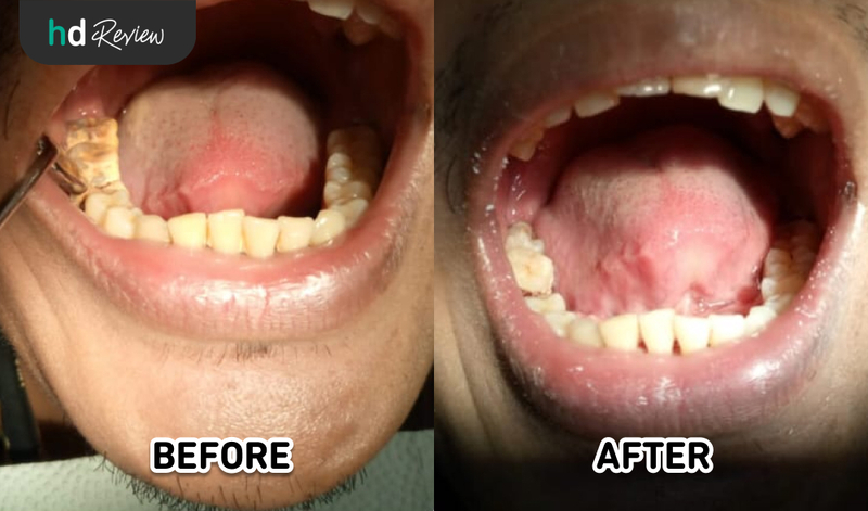 Foto before-after scaling gigi di Difa Oral Health Care