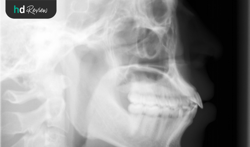 Hasil rontgen cephalometri di Westerindo