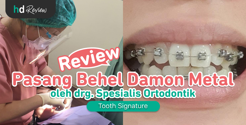 Review Pasang Behel Damon Metal di Tooth Signature, Gigi Rapi Lebih Cepat Tanpa Sakit 