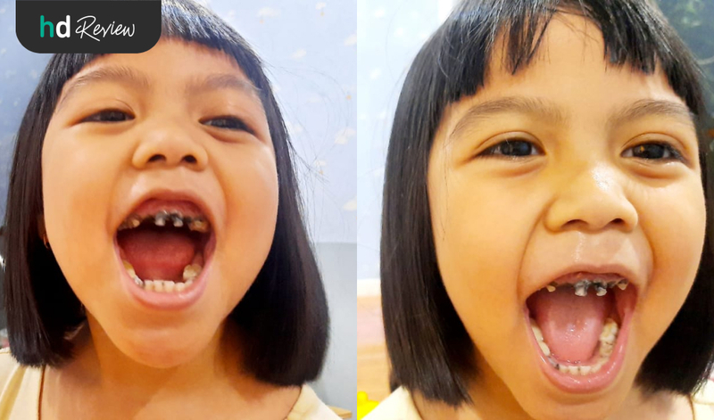 Foto sebelum dan sesudah perawatan saluran akar gigi anak di Beam Dental Clinic