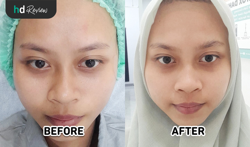 Foto before dan after IPL wajah di Derma Express Foto before dan after IPL wajah di Derma Express
