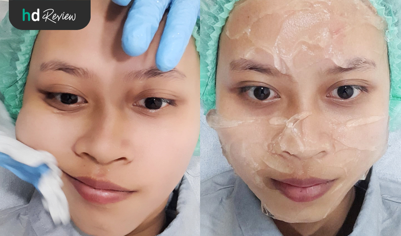 Proses rejuvenation IPL di Derma Express Proses rejuvenation IPL di Derma Express