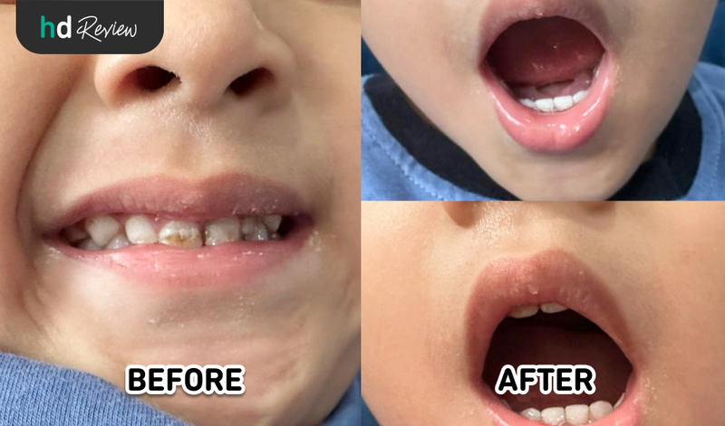 Hasil perawatan fluoride anak di Dentalmate Dentalcare