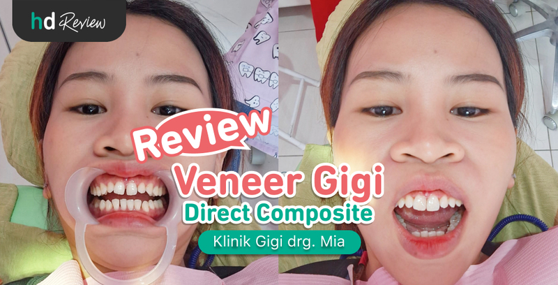 Review Veneer Direct di Klinik Gigi drg. Mia, Senyum Jadi Lebih Pede! Review Veneer Direct di Klinik Gigi drg. Mia, Senyum Jadi Lebih Pede!