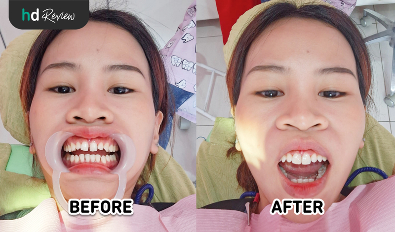 Hasil veneer direct di Klinik Gigi drg. Mia Hasil veneer direct di Klinik Gigi drg. Mia