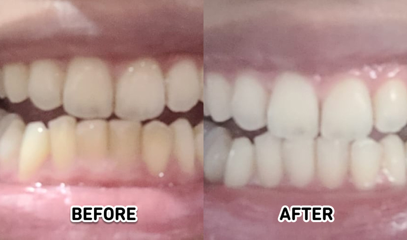 Hasil scaling gigi di Global Estetik