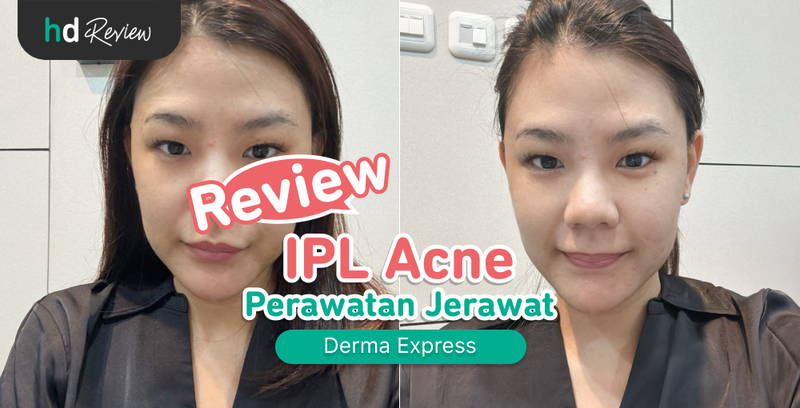 Review IPL Acne di Derma Express, Jerawat Auto Kalem dan Kering setelah Perawatan Review IPL Acne di Derma Express, Jerawat Auto Kalem dan Kering setelah Perawatan