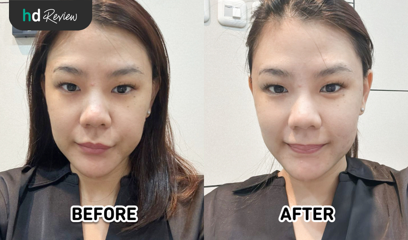 Hasil IPL acne di Derma Express Hasil IPL acne di Derma Express
