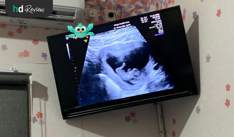 Hasil USG 3D di Emyu Healthcare