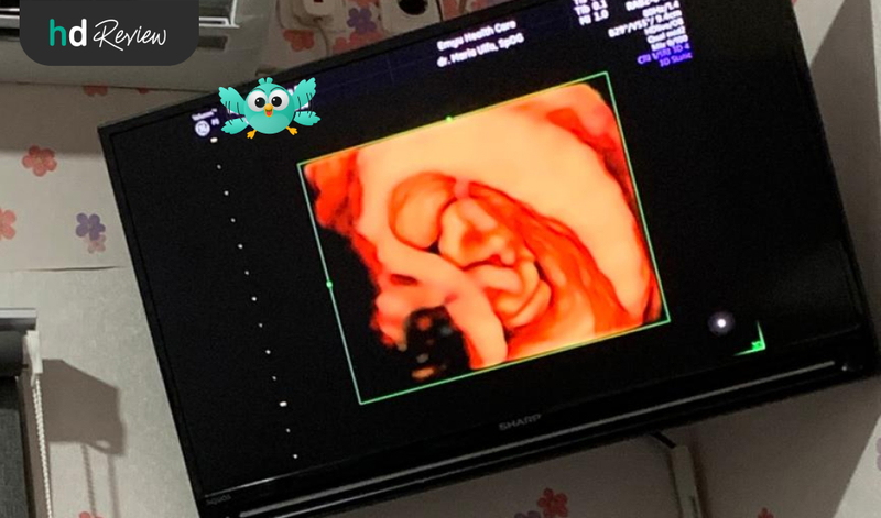 Hasil USG 4D di Emyu Healthcare