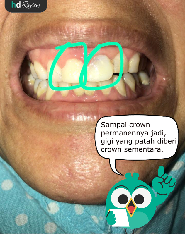 Pengalaman Crown Gigi Sementara di Klinik Gigi Dewi
